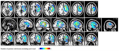 White matter tracts involved in subcortical unilateral spatial neglect in subacute stroke